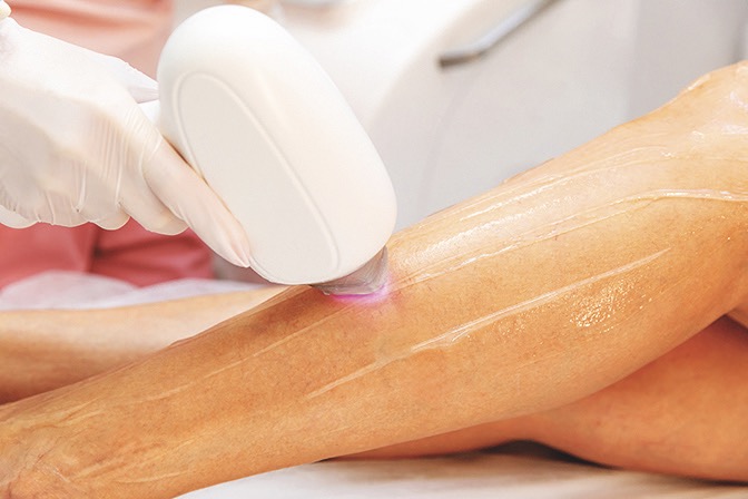 Nechte si chloupky odstranit bezbolestně laserem.