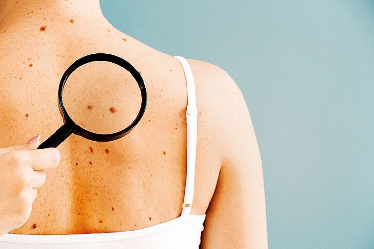 Zkušený dermatolog dokáže poznat změny i s pomocí lupy.
